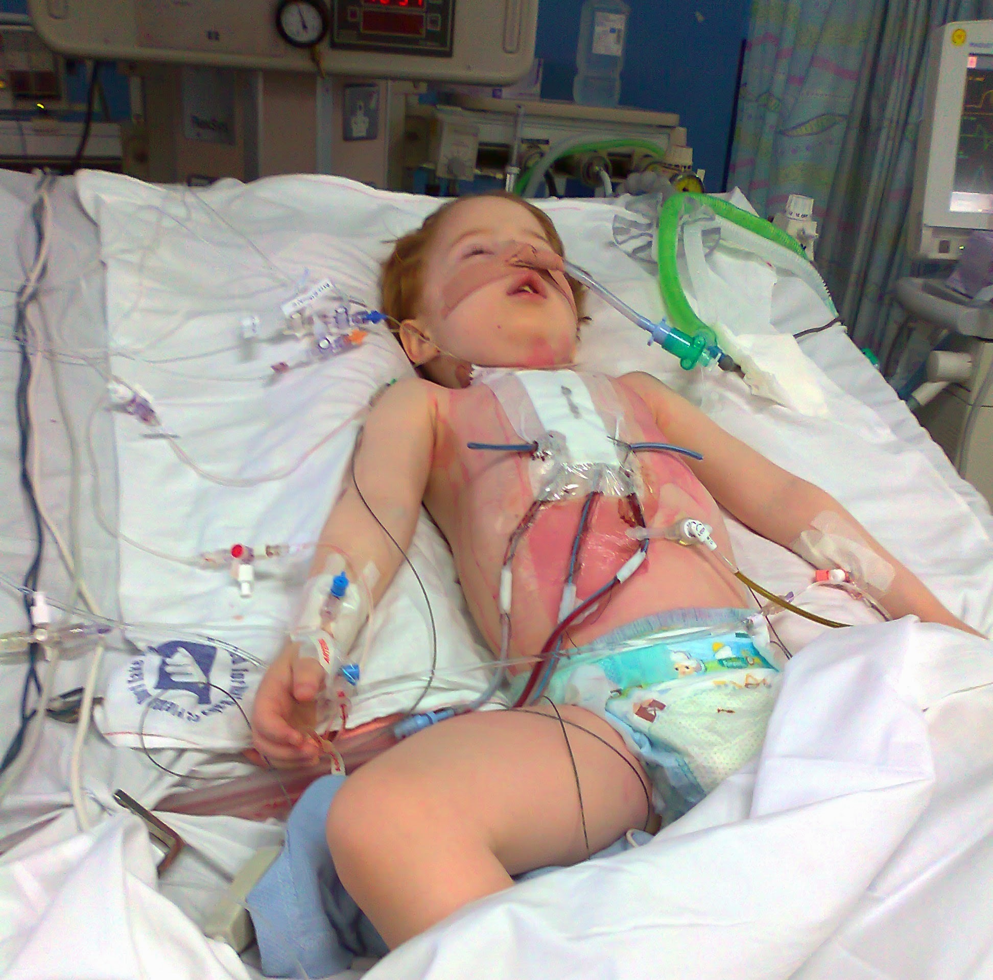 Jack aged 5, in ICU at Birmingham Childrens Hospital after his third open heart surgery. Picture courtesy of the Maddock family