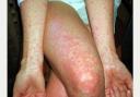 Another Herefordshire school has confirmed cases of scarlet fever. File picture