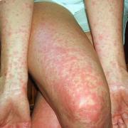 Another Herefordshire school has confirmed cases of scarlet fever. File picture